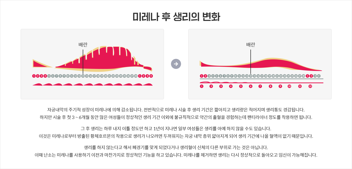 미레나 후 생리의 변화