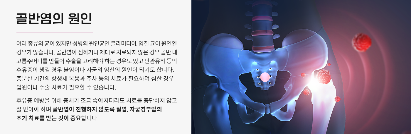 골반염 원인