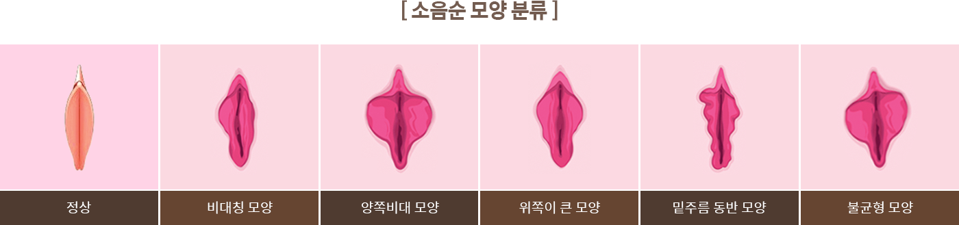 소음순 모양 분류