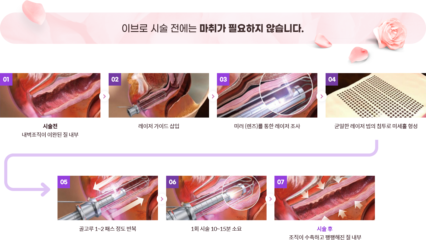 시술과정