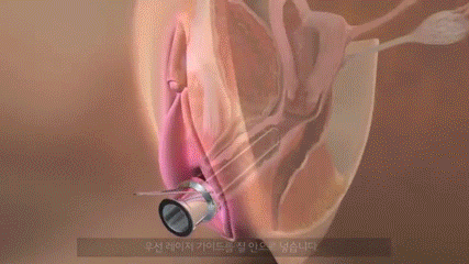 시술과정
